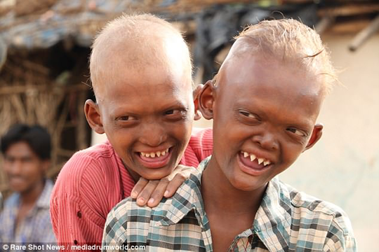 尖牙齿扁鼻子,印度两兄弟长相骇人似"鬼娃"遭村民歧视