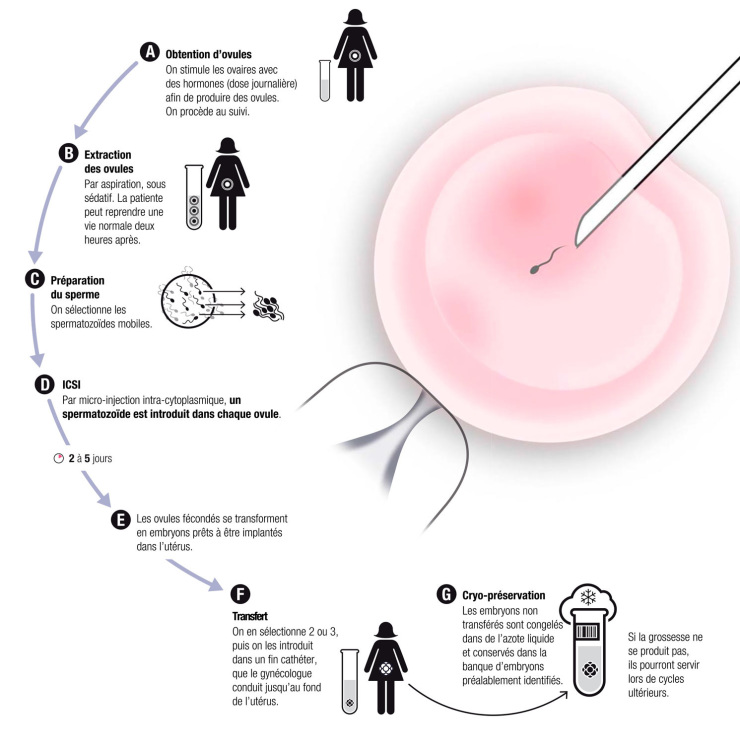 AIC果育:男性精子正常率不足 试管婴儿技术如