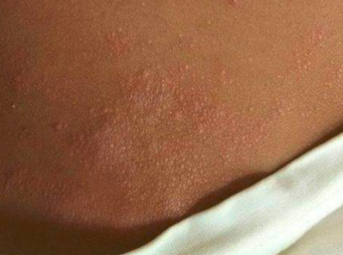 干性湿疹有什么症状?得了干性湿疹怎么办?