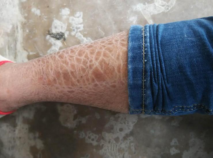 张建疗法:冬季鱼鳞病皮肤干燥如何应对?