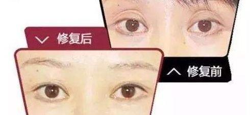 北京伊美尔健翔医院 双眼皮修复手术怎么样