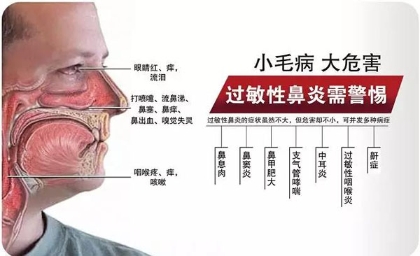博大耳鼻喉名医团成功开展精准治疗过敏性鼻炎新技术