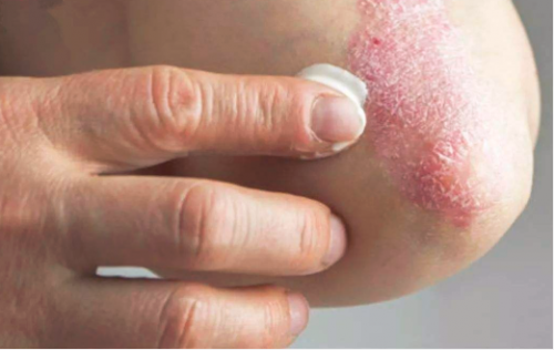 干性湿疹的症状有哪些 教你正确辨认干性湿疹