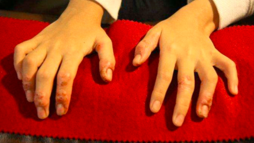 手指湿疹多年能好吗?这些禁忌要注意_