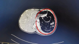 萍乡：少女腹腔中发现“巨大肿瘤” 专家耐心分离精准“拆除”